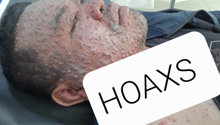 IMIP Klarifikasi Informasi Hoax Virus Cacar Monyet