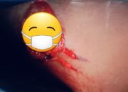Kecelakaan Kerja, Karyawan PT RUJ Luka Serius di Paha